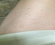 (Upper thigh) These scars are the worst. They are like faded enough that I feel like I did a bad job, but not faded enough to not be visible in a swimsuit. They also turn purple when cold which only makes them more visible. X-x from visible